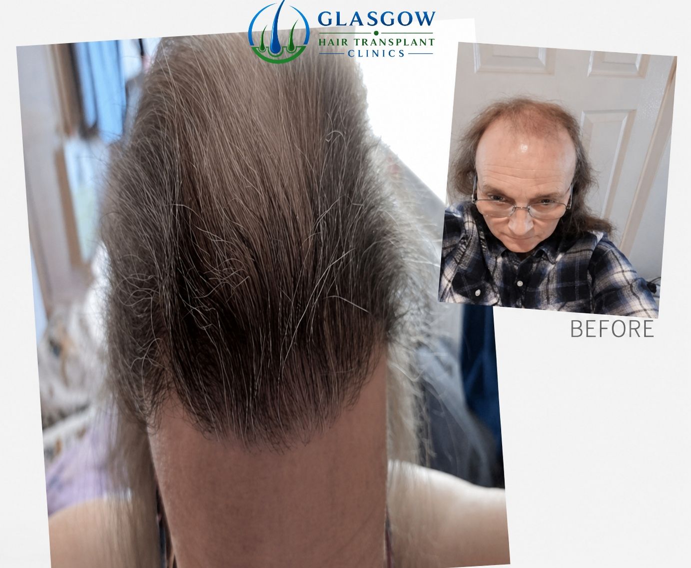 Transgender hair transplant Glasgow