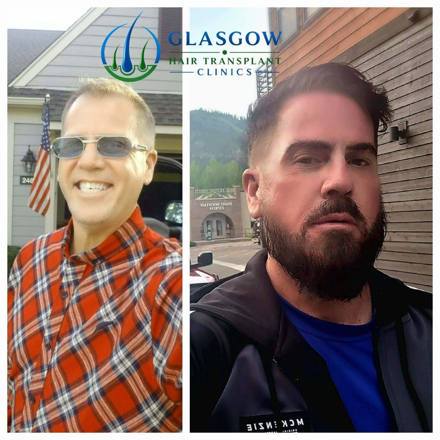 Facial hair transplant result