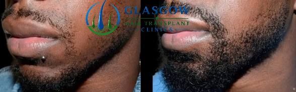 Beard transplant result Glasgow