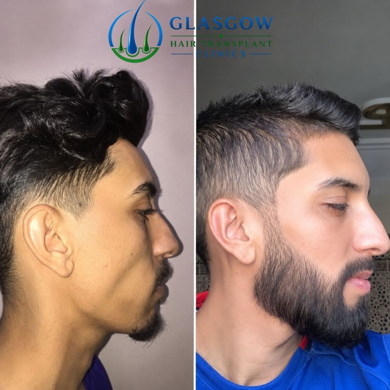 Beard restoration result Glasgow