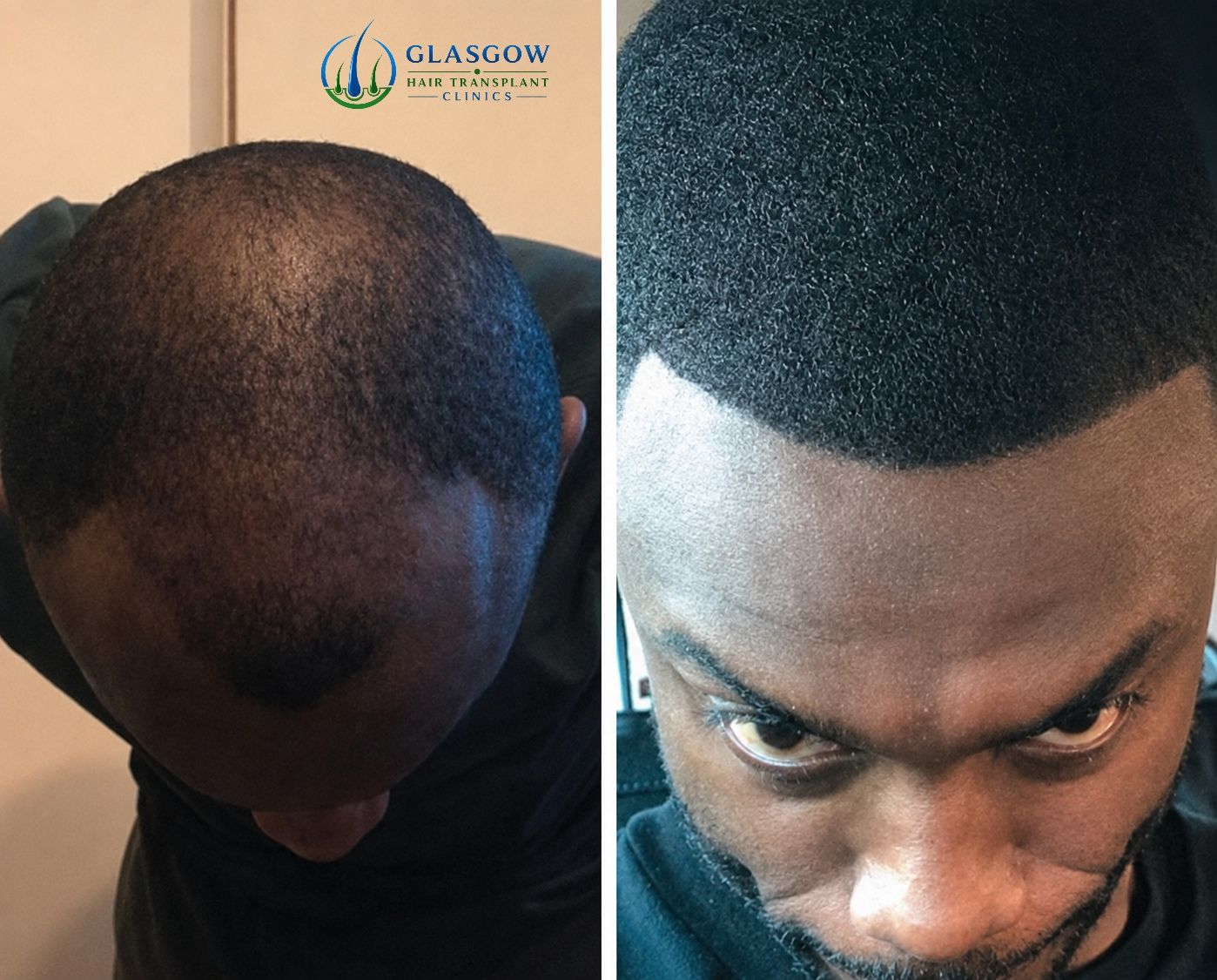 Afro textured hair transplant result Glasgow