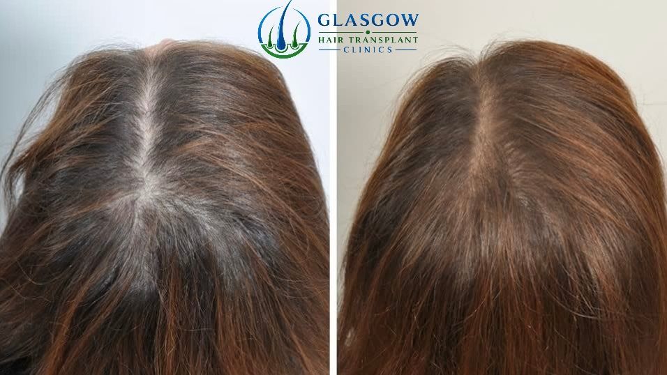 Results after three PRP sessions at four months