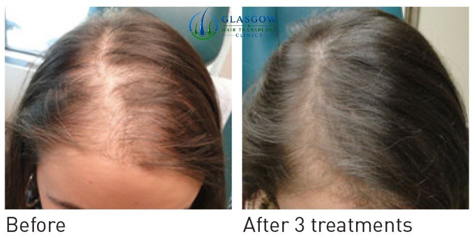 Results after five PRP sessions at six months