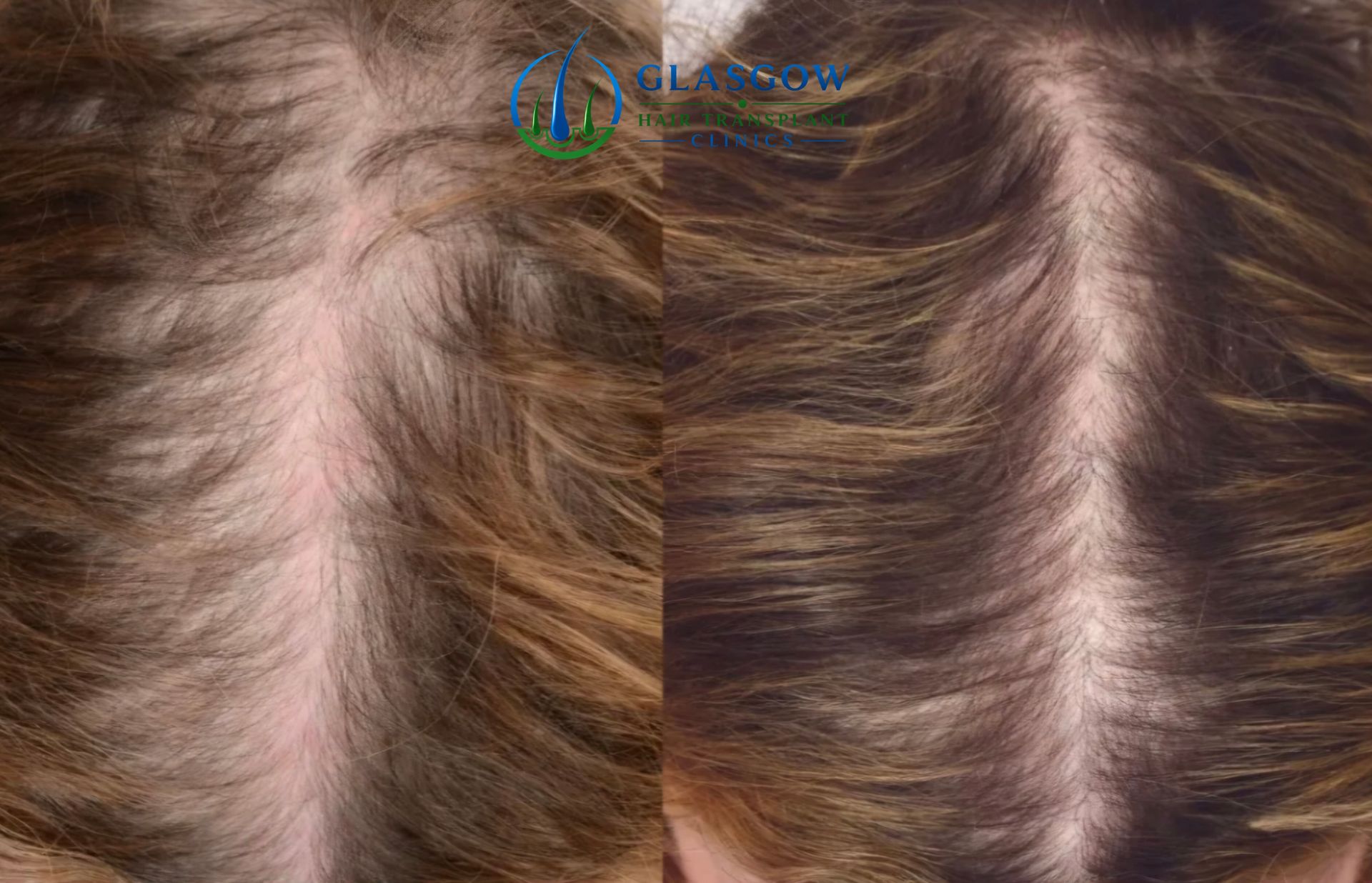 Results after four PRP sessions at five months