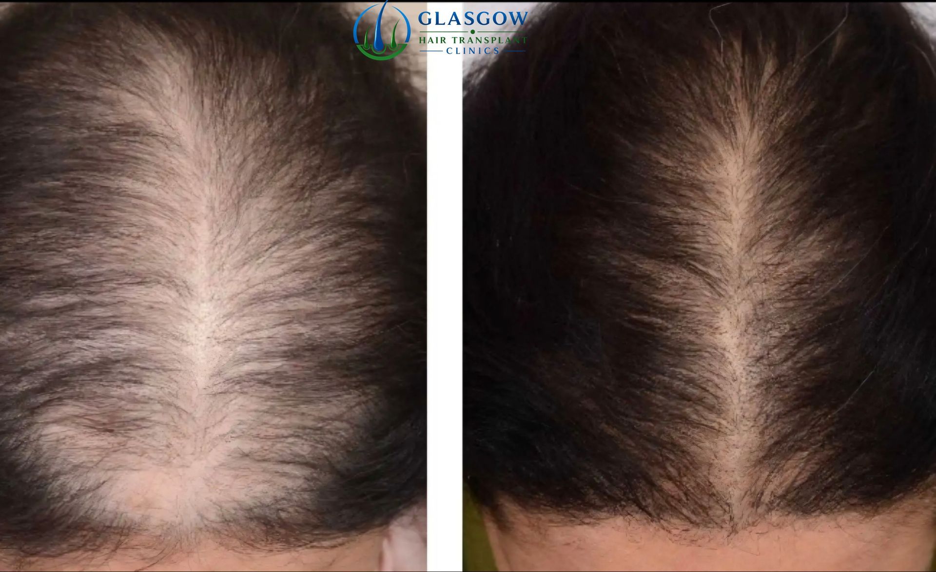 Results after six PRP sessions at nine months