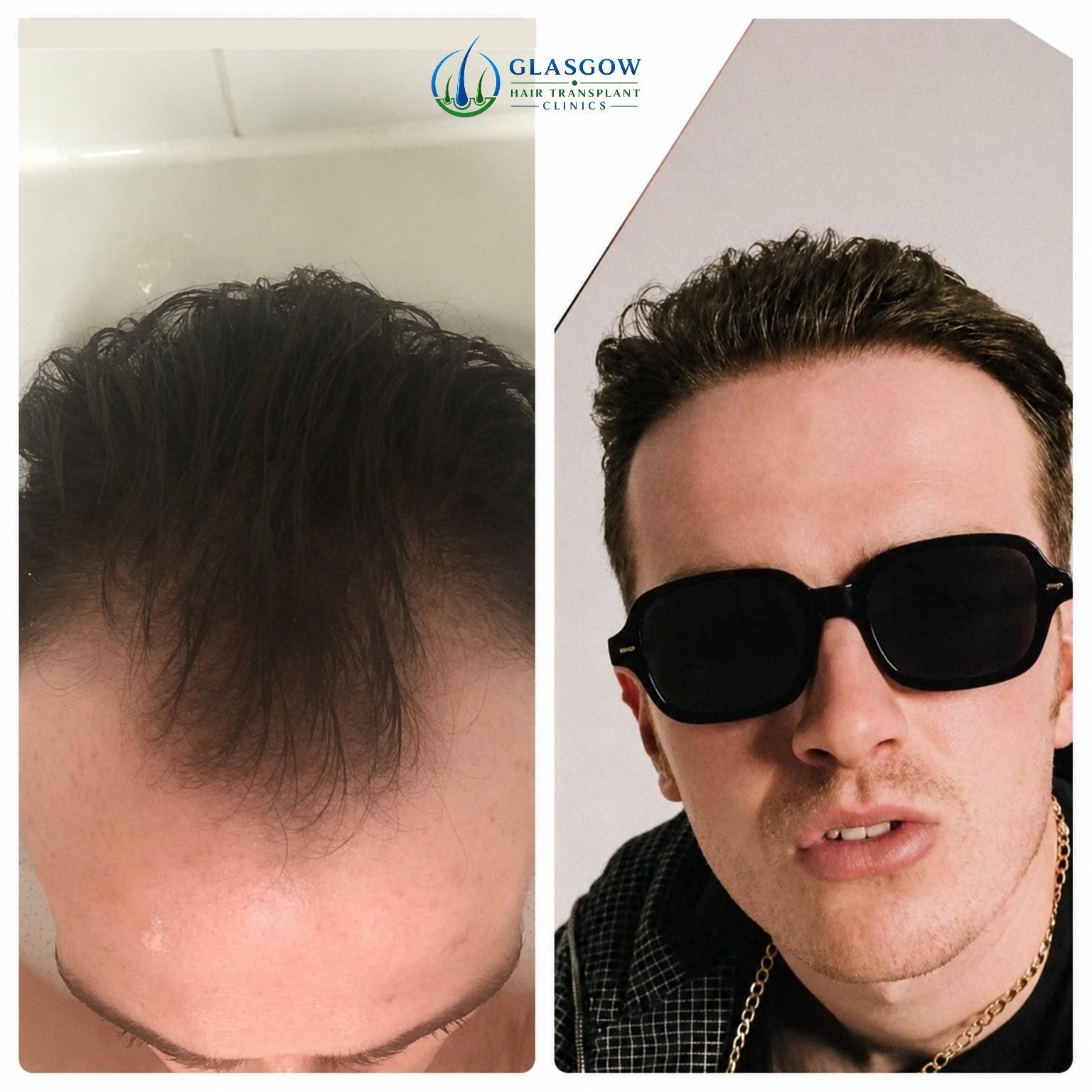Before and five-month result after a 2,300 graft widow's peak hair transplant