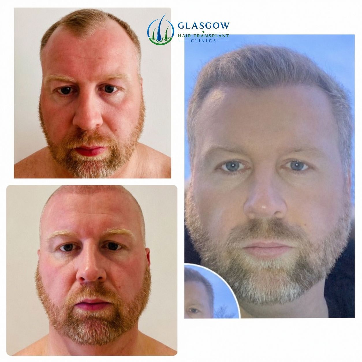Before and approximately twelve-month result after a 2,850 graft widow's peak transplant