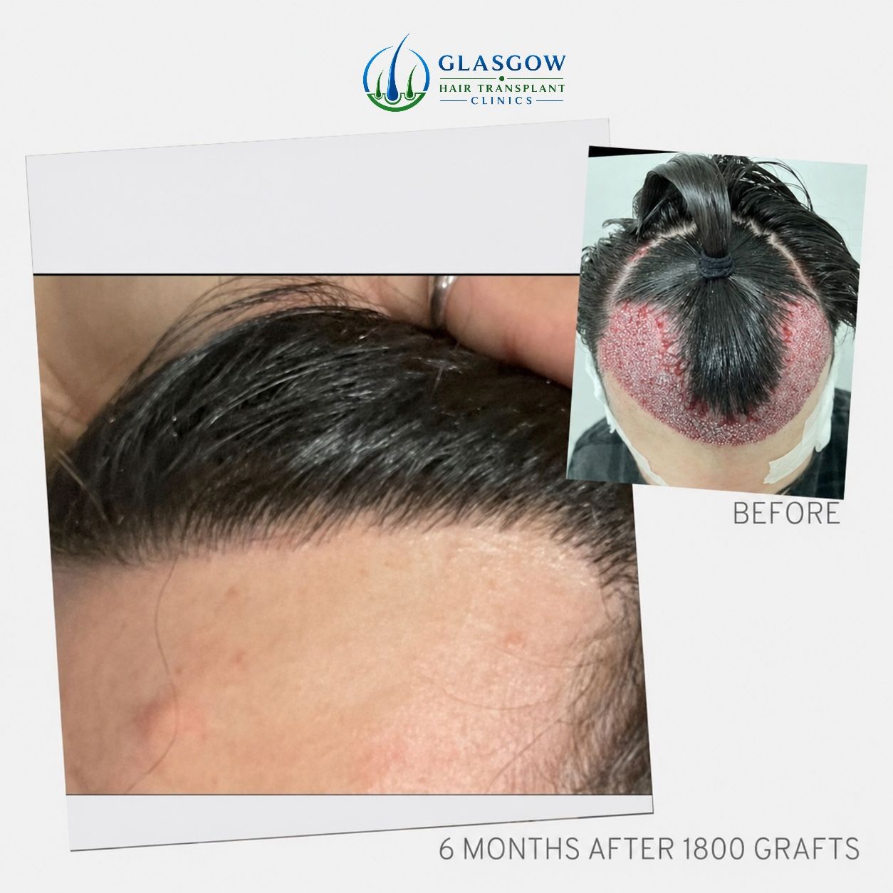 Before and approximately six-month result after a 1,800 graft widow's peak transplant