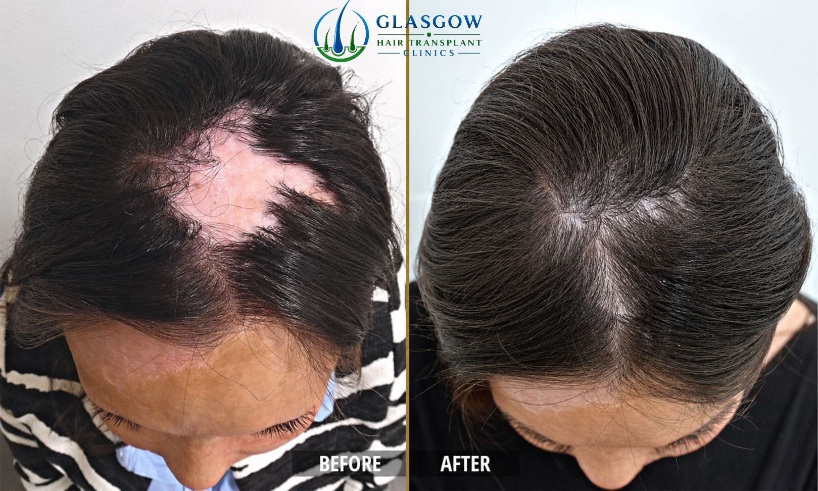 Hair transplant for scar repair