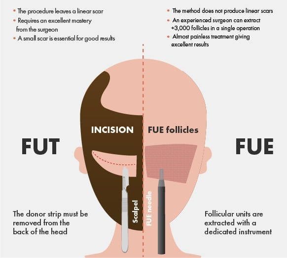 Hair transplant treatment for scar tissue