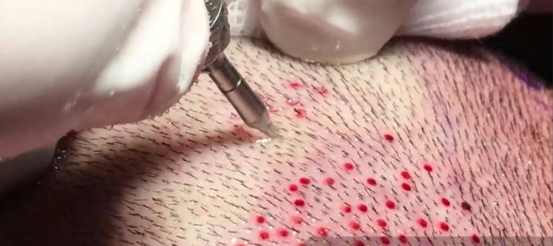 FUE hair transplant for scar repair