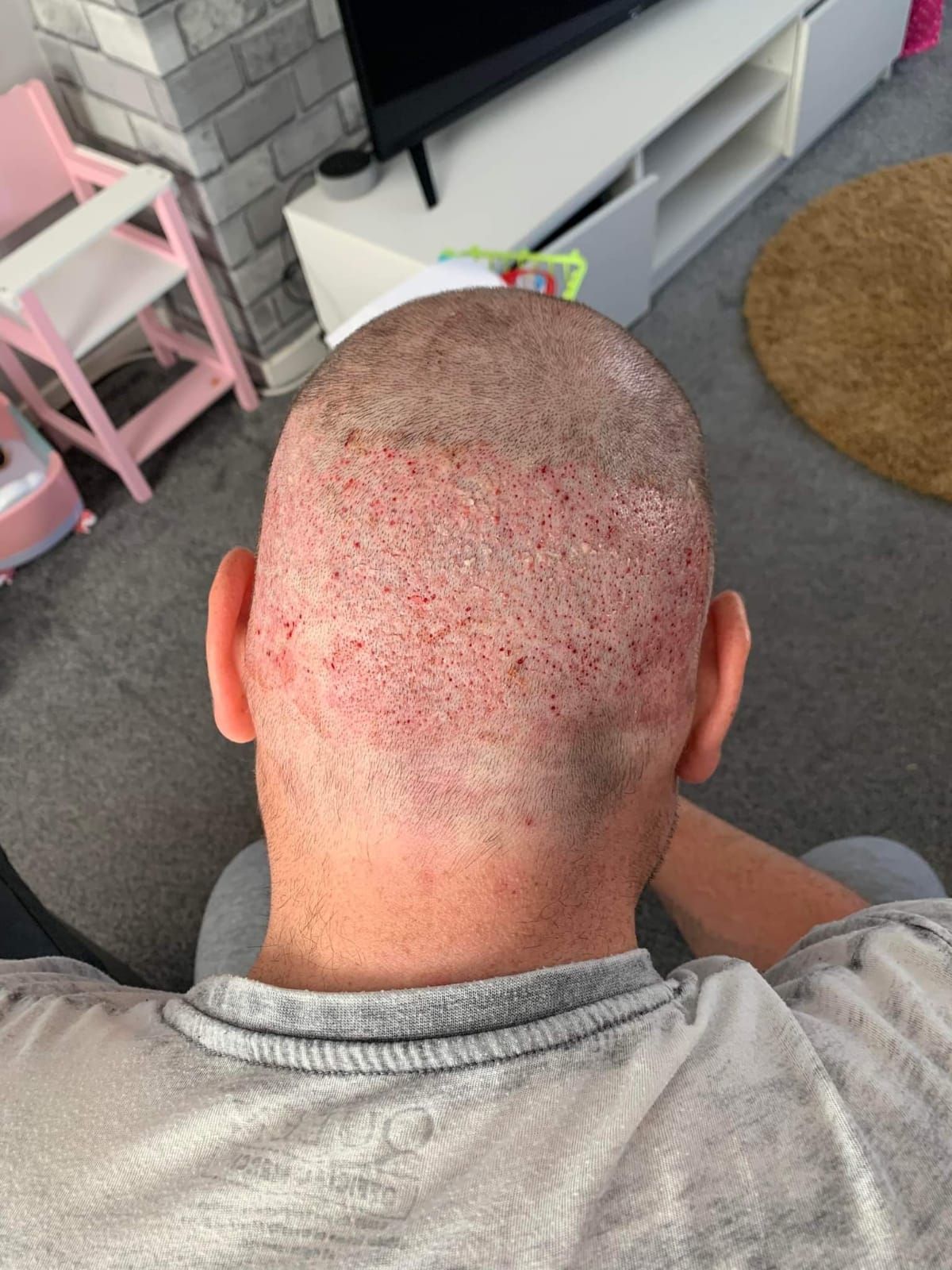 Back and crown of a patient before surgery, showing crown thinning and the donor hair below