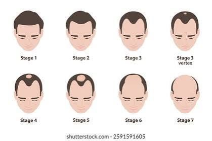Male pattern baldness