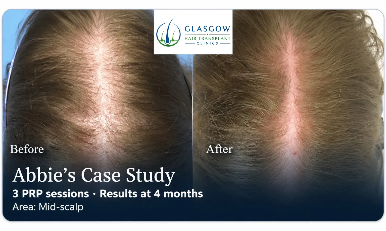 Abbie: PRP, Mid-scalp, 3 prp sessions, results at 4 months