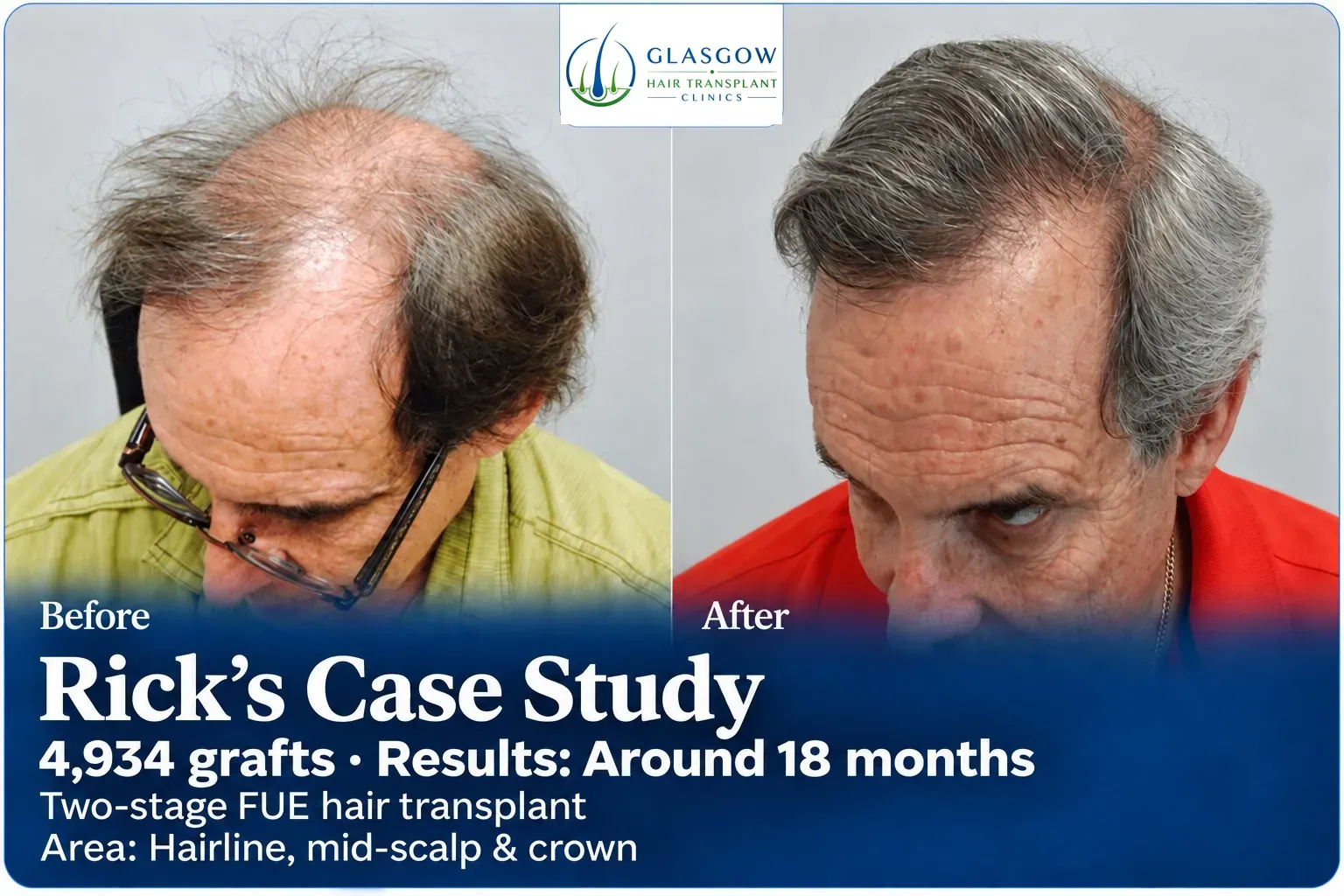Rick: Two-stage FUE, Hairline, mid-scalp and crown, 4,934 grafts, results at 18 months