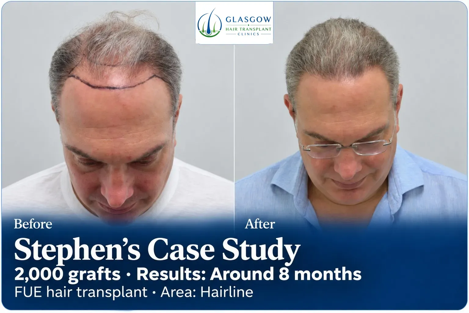 Stephen: FUE, Hairline, 2,000 grafts, results at 8 months