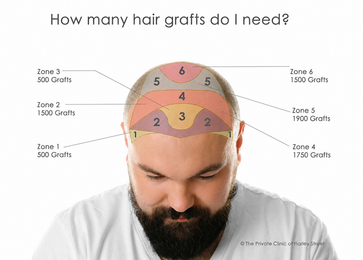 Hair transplant graft-zone diagram showing estimated graft counts for the hairline, mid-scalp and crown areas.