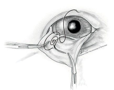 Third Eyelid Repair- Nictating Membrane. Final suture step to close repair. One of a series of ophthalmological surgical illustrations to accompany book chapters by Drs. Dan Ward and Diane Hendrix in Gelatt’s Veterinary Ophthalmology, 2nd–4th editions and Essentials of Veterinary Ophthalmology, 1st edition. Carbon pencil and Faber-Castell® pencils on BFK Rives® paper.Illustration by Deborah K. Haines ©1997 The University of Tennessee.