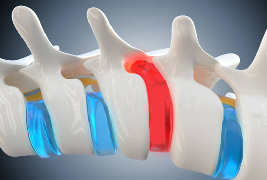 Herniated Disc