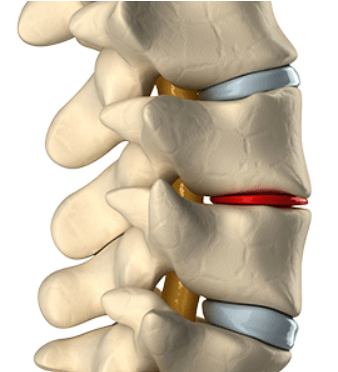 Picture of degenerative disc