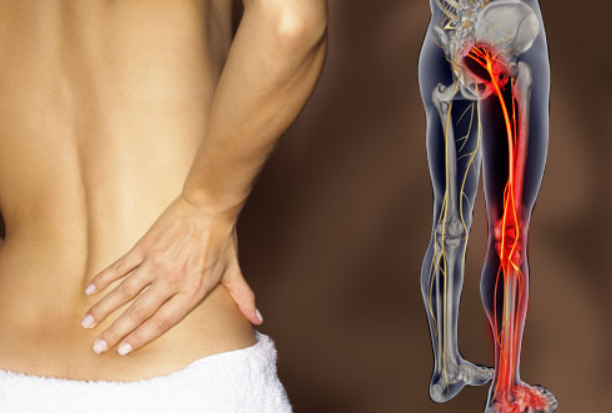 Picture that demonstrations the painful area from the top of the right buttocks all the way down through the foot.