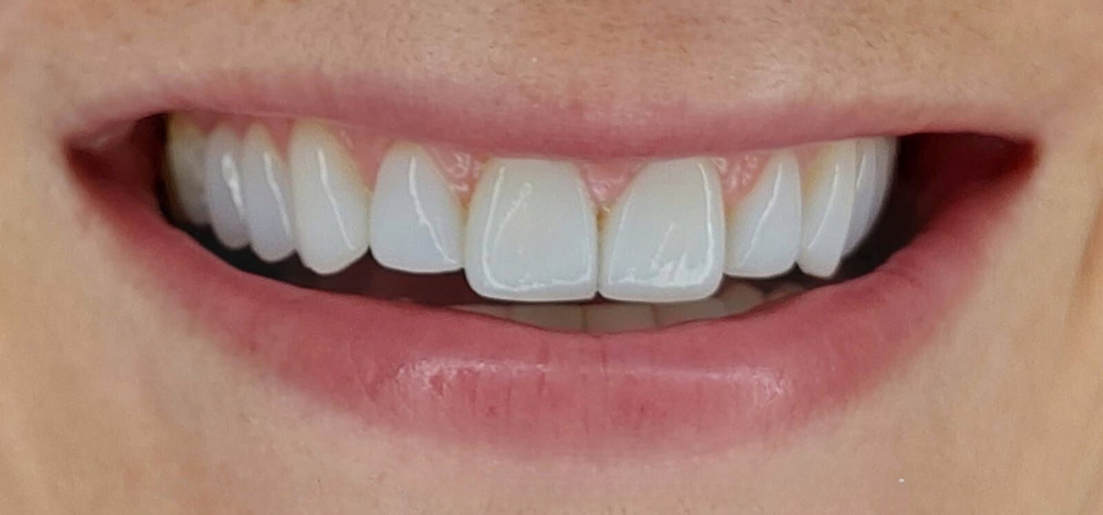 Un primer plano de la boca de una persona con dientes blancos.
