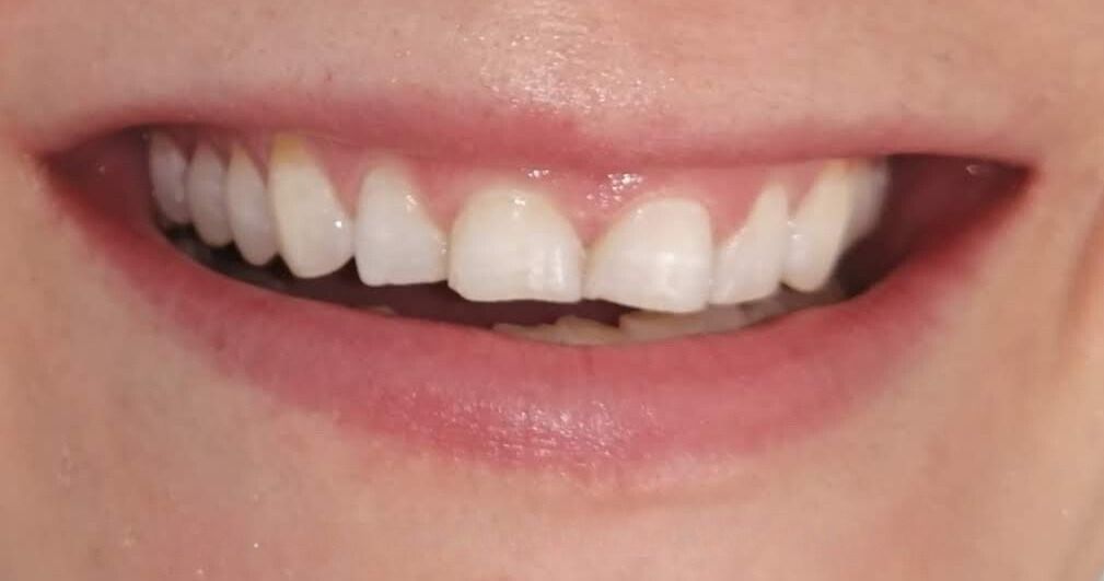 Un primer plano de la boca de una persona con dientes blancos.