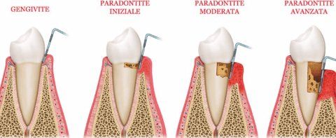 parodontite