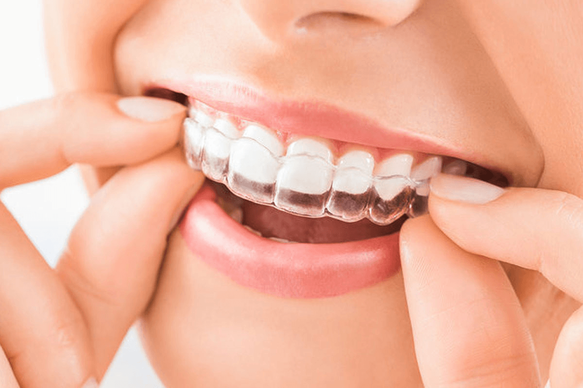 Woman wearing Clear Aligners