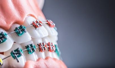 Close up of colorful Braces