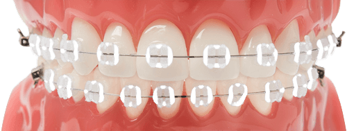 Close up of white Braces
