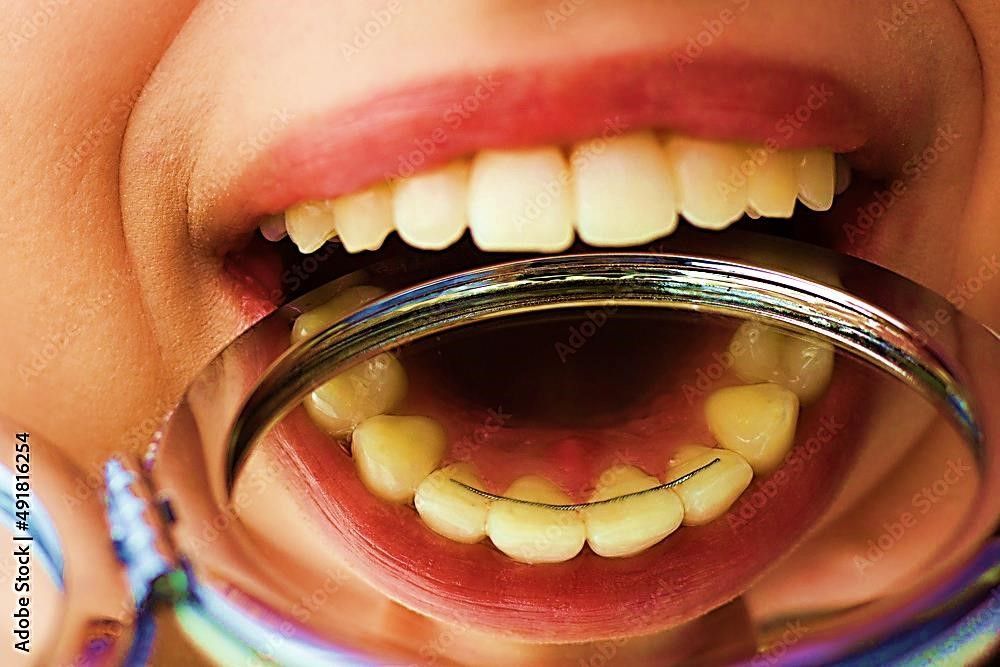 Using a mirror to check the back sides of Teeth