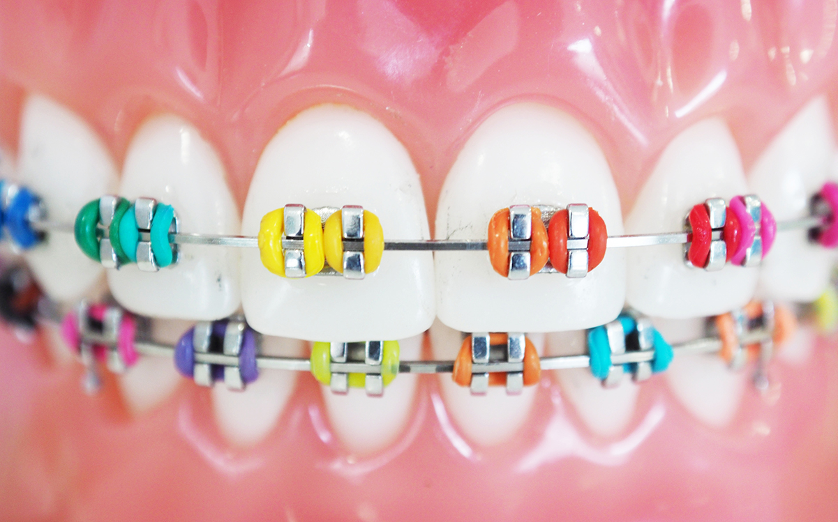 Close up of colorful Braces (2)