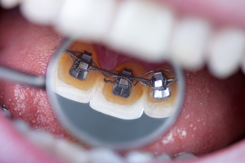Close Up Braces Behind the Teeth