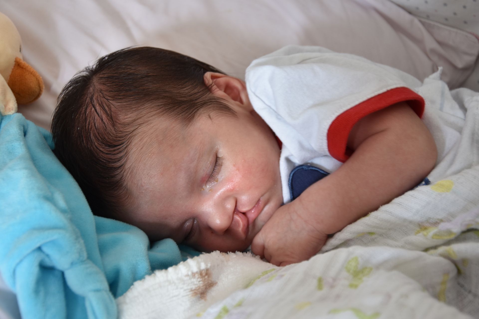 Baby with Cleft lip and cleft palate