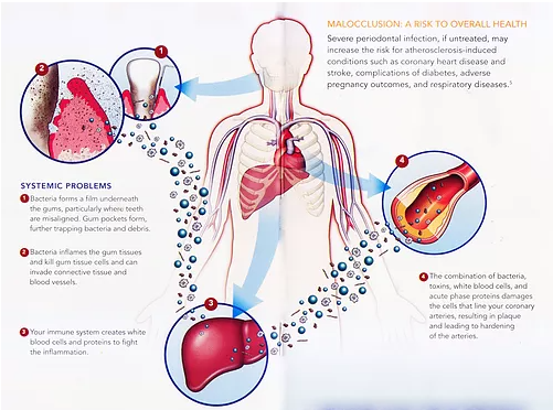 Malocclusion: A Risk to Overall Health