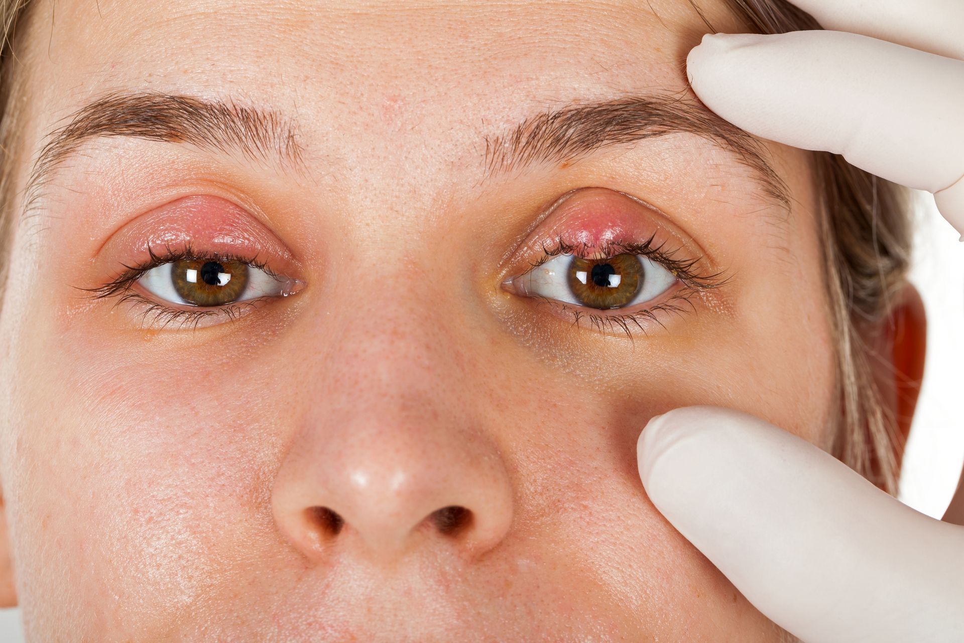 Ophthalmic Infection — Pocatello, ID — Eyecare Of Southeast Idaho Ophthalmic Infection — Pocatello, ID — Eyecare Of Southeast Idaho