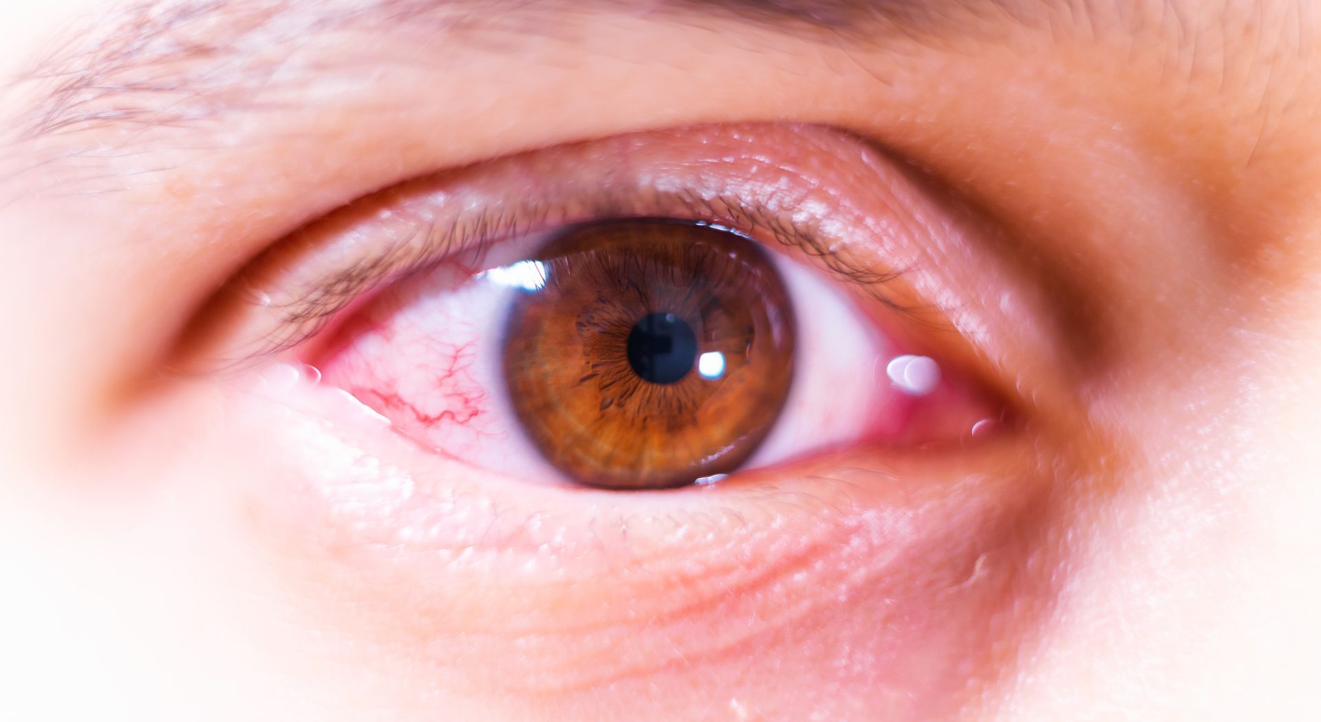 Irritated Brown Eye — Pocatello, ID — Eyecare Of Southeast Idaho Irritated Brown Eye — Pocatello, ID — Eyecare Of Southeast Idaho