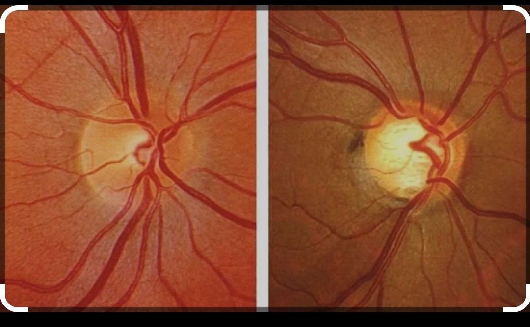Irritated Brown Eye — Pocatello, ID — Eyecare Of Southeast Idaho