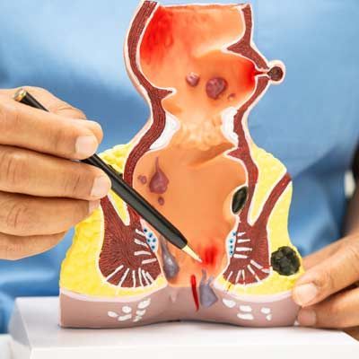 Hand holding a pencil, pointing to a cutaway anatomical model of the uterus with Hemorrhoids