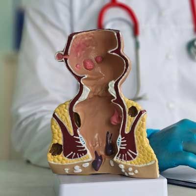 Transabdominal ultrasonography detects ulcers and diverticulosis