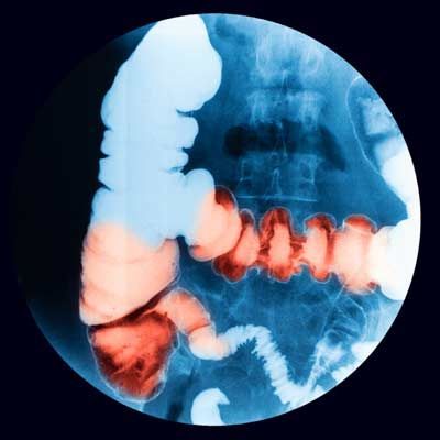 Fluoroscopic examination of the lower gastrointestinal (GI) Tract, Barium enema exam (BE), Ulcerative colitis