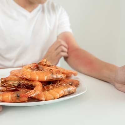 A man breaks out with a rash on his arm from a shrimp food allergy