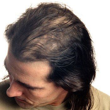 Hair replacement services in Scarsdale, NY