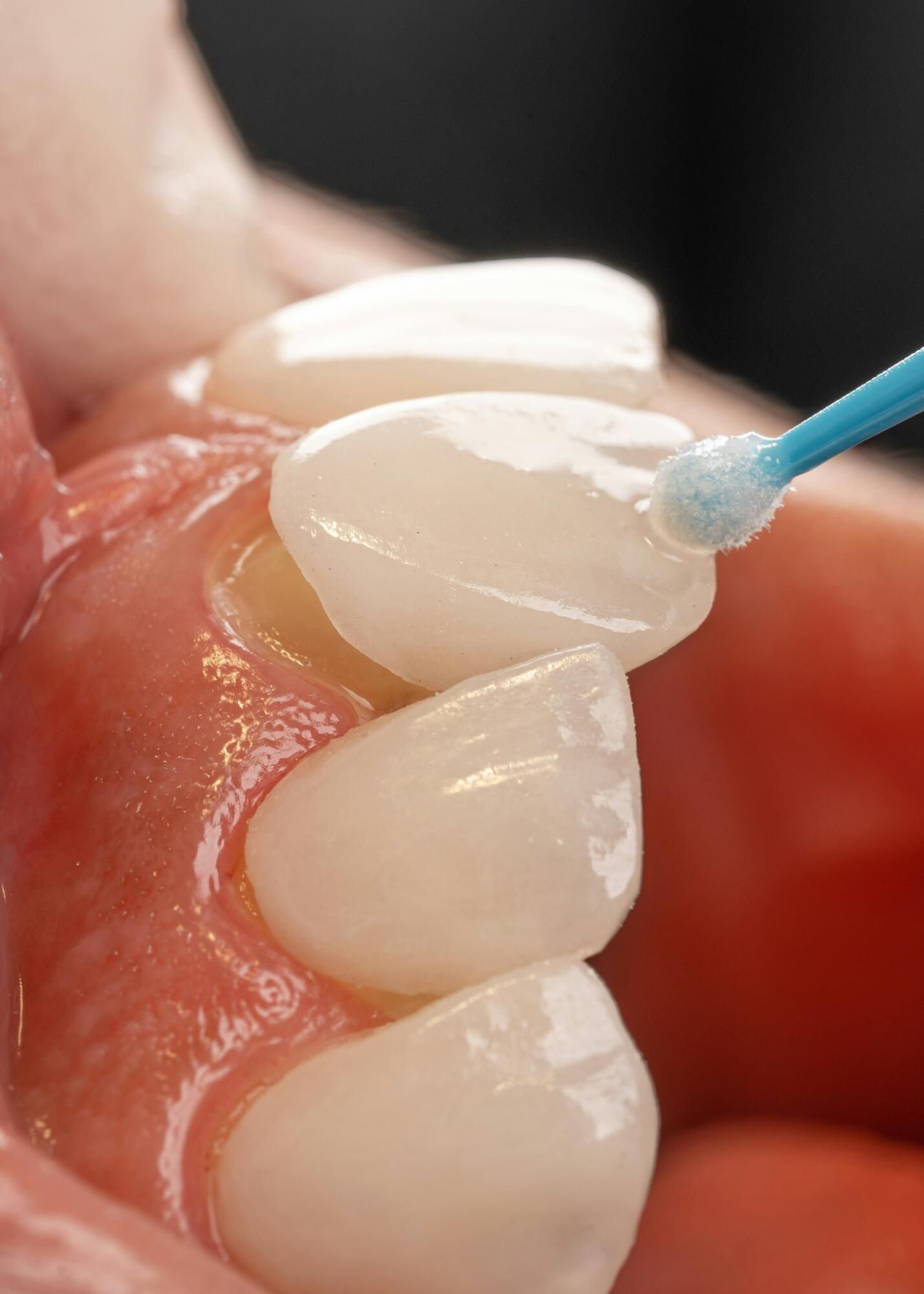 Dental procedure: teeth being treated with a small applicator brush, showing close-up of teeth and gums.