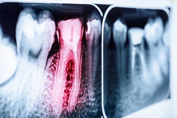 A close up of an x-ray of a tooth with a hole in it.