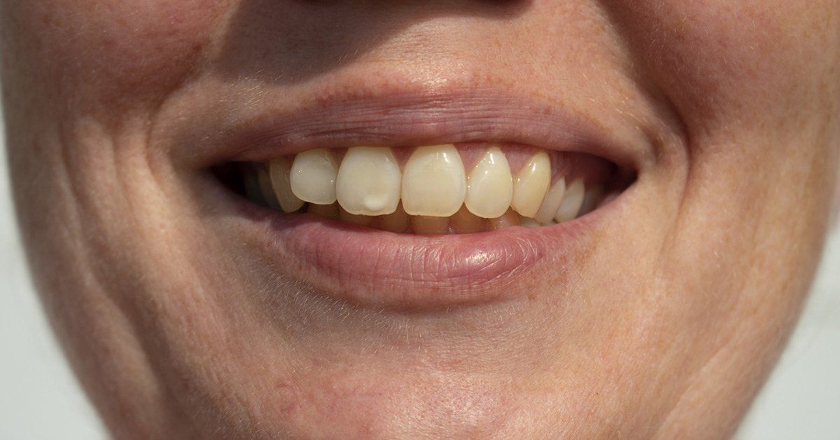 A close up of a woman 's mouth with white teeth