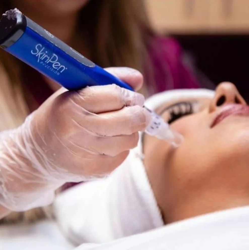Microneedling with or without PRP