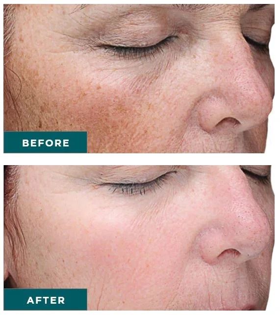 A gentle, medical-grade resurfacing peel