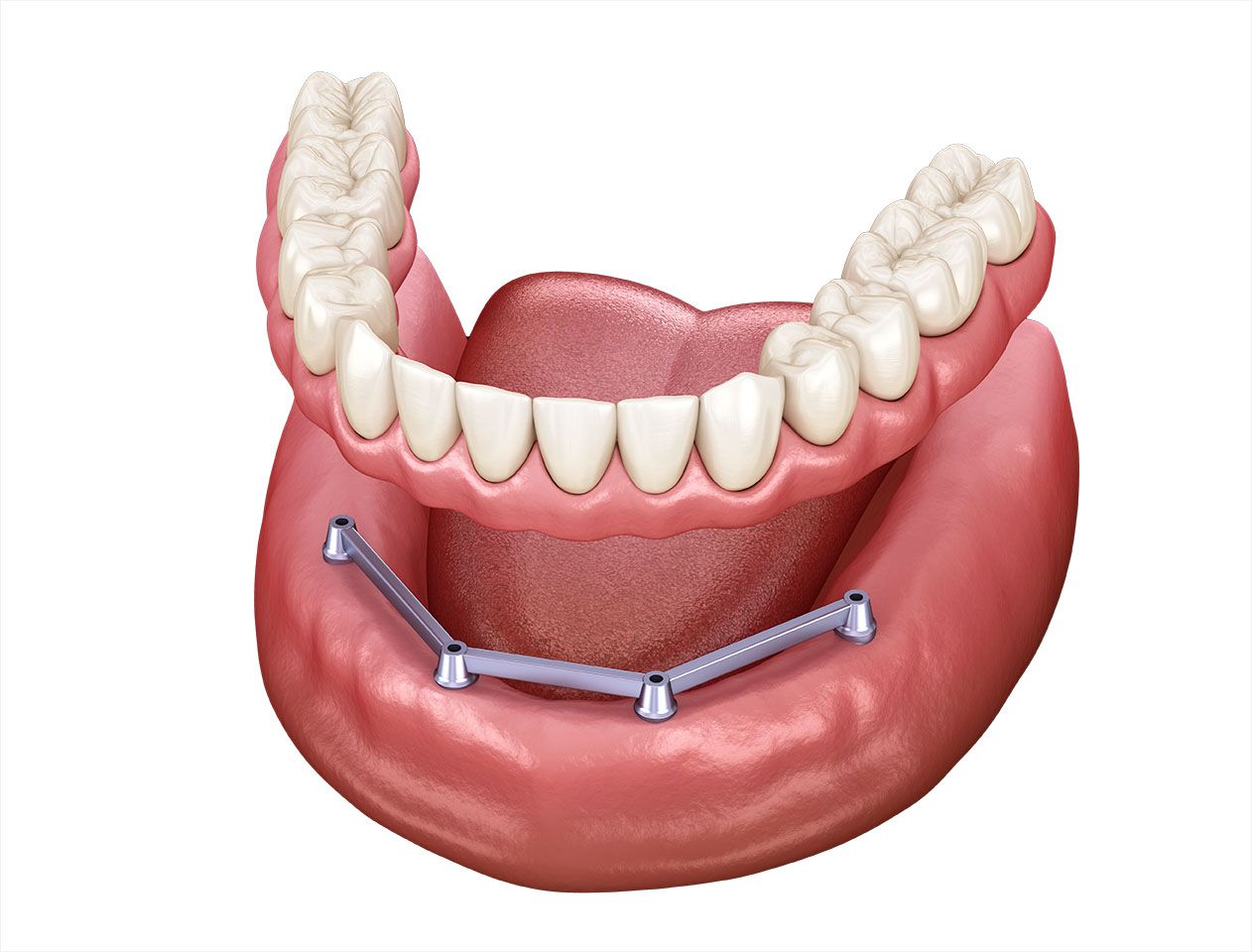 dentures